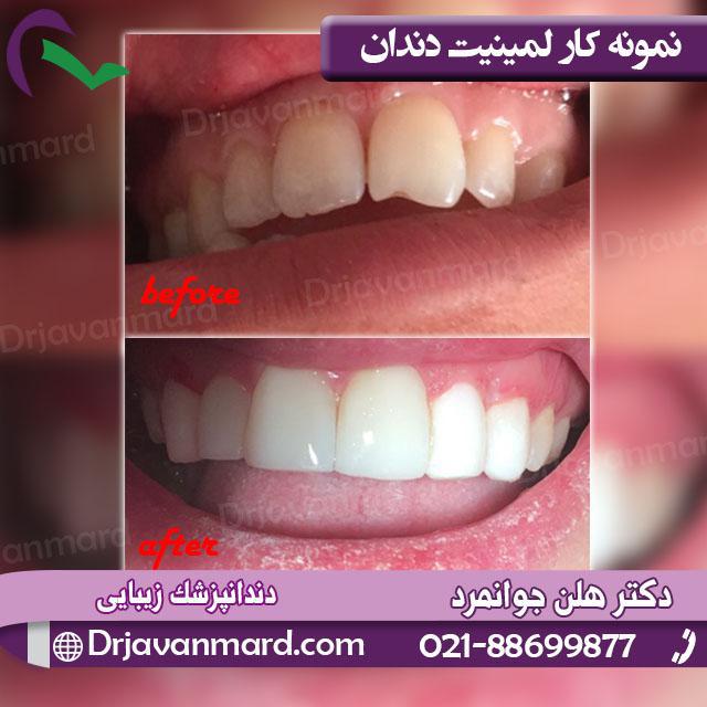 انواع لمینیت دندان