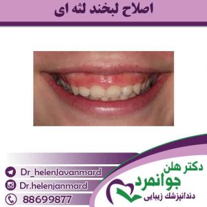 اصلاح-لبخند-لثه-ای