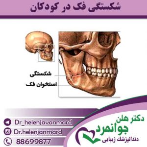 شکستگی-فک-در-کودکان