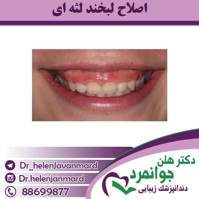 اصلاح لبخند لثه ای