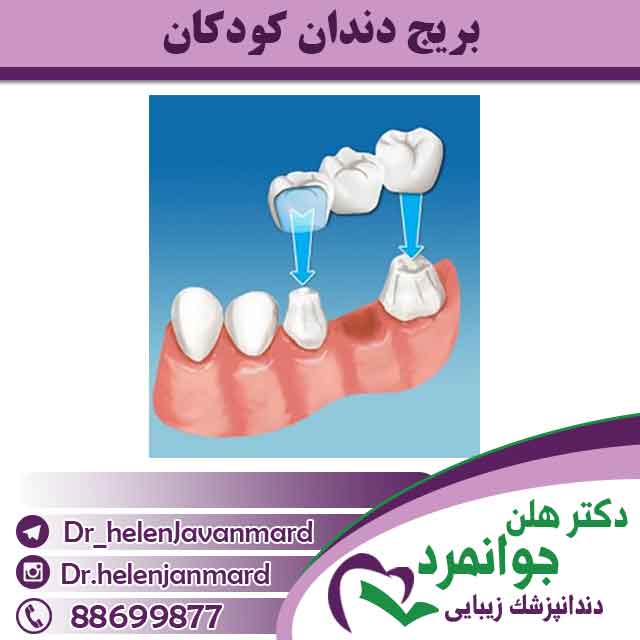 بریج دندان کودکان