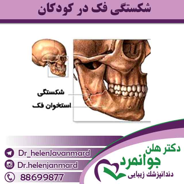 شکستگی فک در کودکان