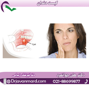کیست دندان