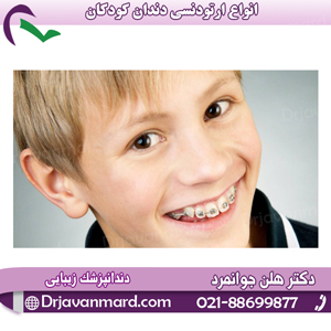 انواع ارتودنسی دندان کودکان