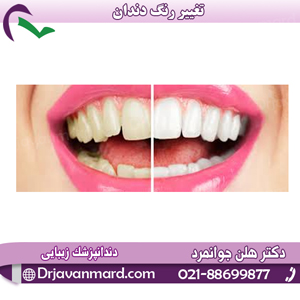 تغییر-رنگ-دندان