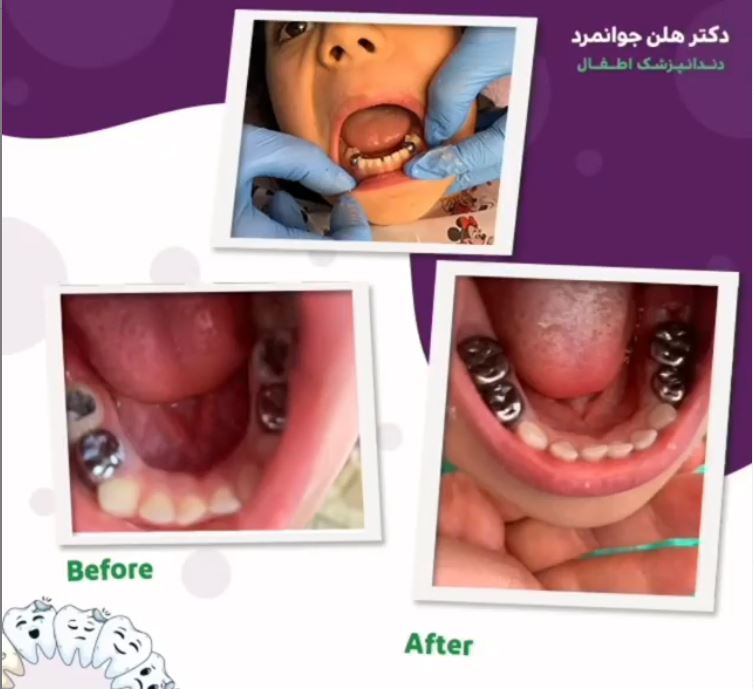 دندانپزشکی کودکان با بیهوشی