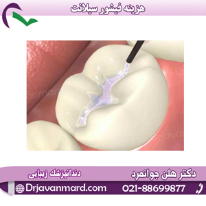 هزینه-فیشور-سیلانت