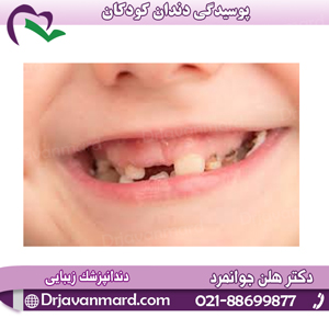 پوسیدگی دندان کودکان