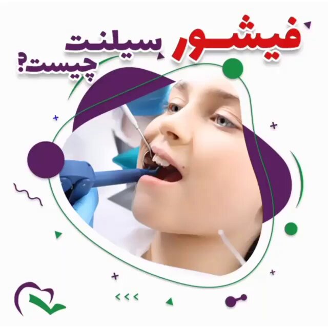 فیشور سیلانت