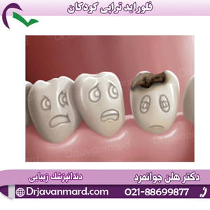 فلوراید تراپی کودکان