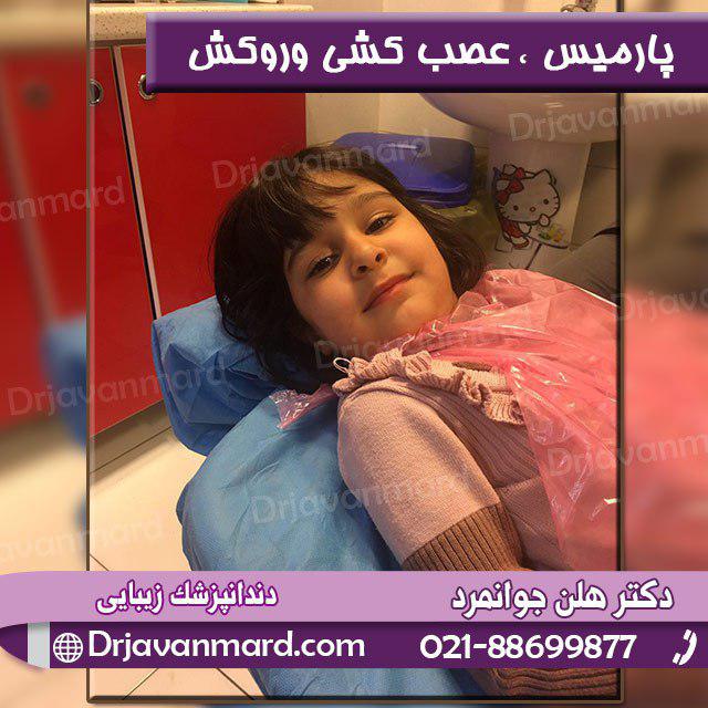 عصب کشی دندان پارمیس عزیز