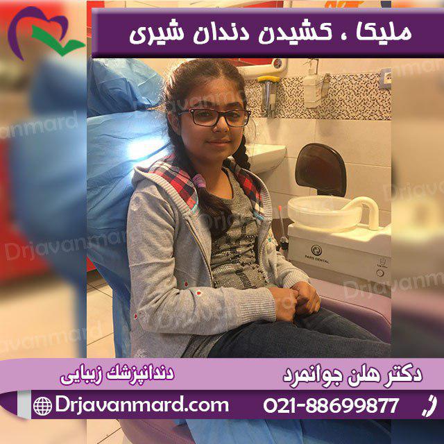 کشیدن دندان شیری توسط دکتر هلن جوانمرد