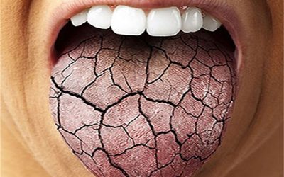 روش های درمان خشکی دهان