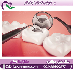 پر کردن دندان کودکان با دکتر هلن جوانمرد