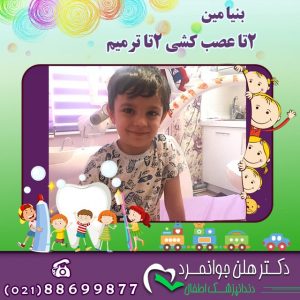 عصب کشی دندان