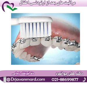 مراقبت های بعد از ارتودنسی اطفال