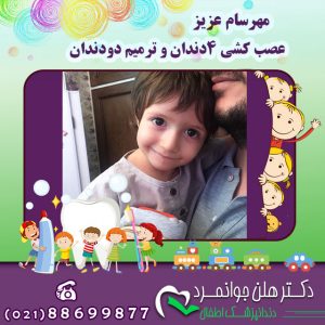 درمان دندان نهفته کودکان