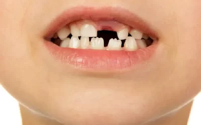 دیر افتادن دندان شیری