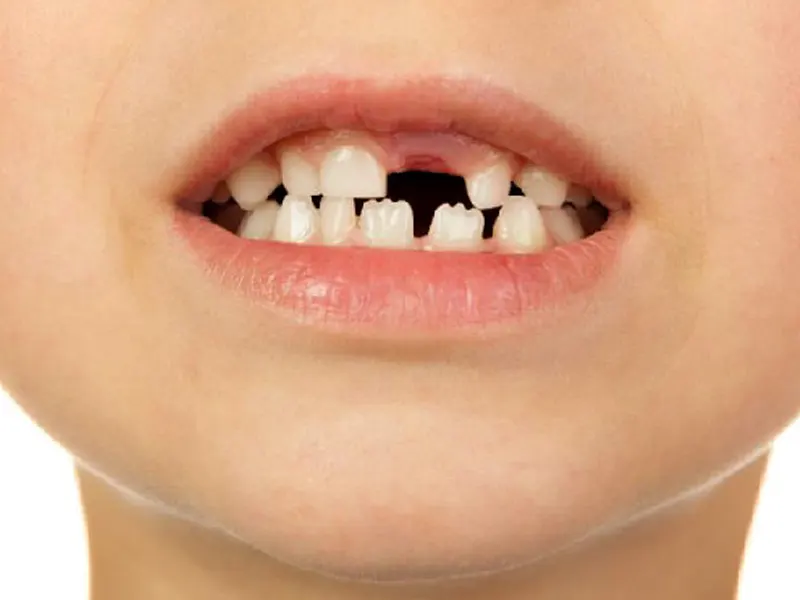 دیر افتادن دندان شیری