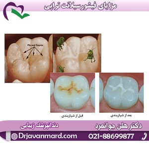 مزایای فیشورسیلانت تراپی