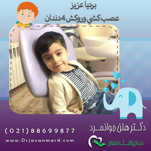 عصب کشی و روکش دندان بردیا عزیز