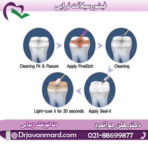 فیشورسیلانت تراپی، راهی برای پیشگیری از پوسیدگی دندان ها