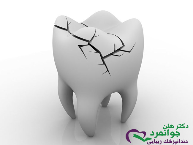 دندان شکسته کودکان