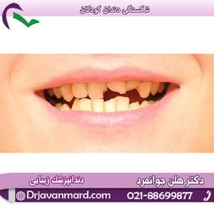 شکستگی دندان کودکان