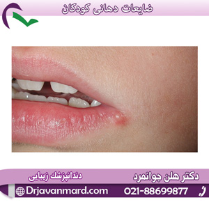 ضایعات دهانی کودکان