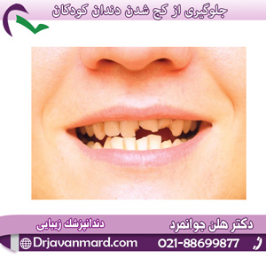 در مورد کج شدن دندان کودکان بیشتر بدانید