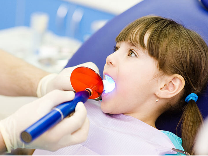 فیشور سیلانت دندان شیری