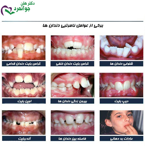 نامرتبی دندان ها