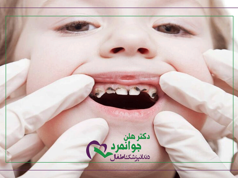 نامرتبی دندان در کودکان