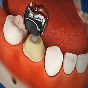 روکش دندان های شیری