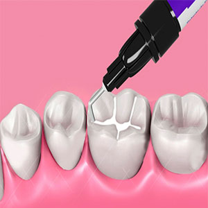 شیار بندی دندان کودکان