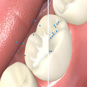 فلوراید تراپی کودکان