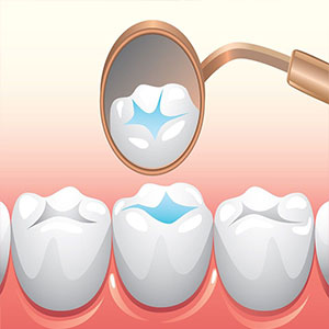 فیشورسیلانت کودکان