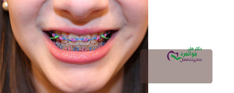 ارتودنسی دندان کودکان