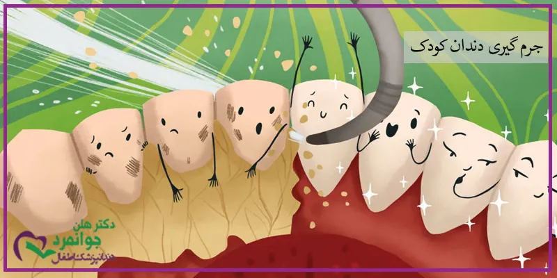 جرم گیری یکی از روش های جلوگیری از پوسیدگی دندان ها محسوب می شود که تمامی رسوبات باقی مانده از غذا های مصرفی بر روی سطوح مختلف دندان ها را می زداید.