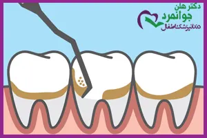 نحوه-انجام-جرم-گیری