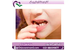 ضربه-به-دندان-شیری