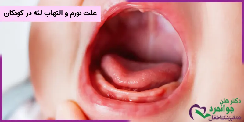 لثه های سالم کودکان به طور معمول بافت صورتی رنگ، سفت و فیبری داشته و در صورتی که لثه ها متورم شوند حجیم و به رنگ قرمز تیره مشاهده خواهند شد. تورم و التهاب لثه ها دلایل مختلفی از جمله درآوردن دندان و وارد شدن ضربه ناگهانی به دندان ها، انحراف و کج شدن دندان کودک که منجر به انباشته شدن غذا و تشکیل سینوس های دهانی می شود، ابتلای کودک به بیماری دیابت و ابتلای کودک به بیماری اسکوربوت به دلیل کمبود ویتامین c اشاره کرد. دلایل دیگری نیز در تورم لثه های کودکان ممکن است که تاثیر داشته باشند. در ادامه به بررسی آن ها خواهیم پرداخت.