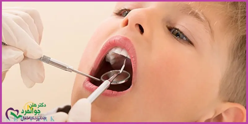 درمان-دیر-افتادن-دندان-شیری