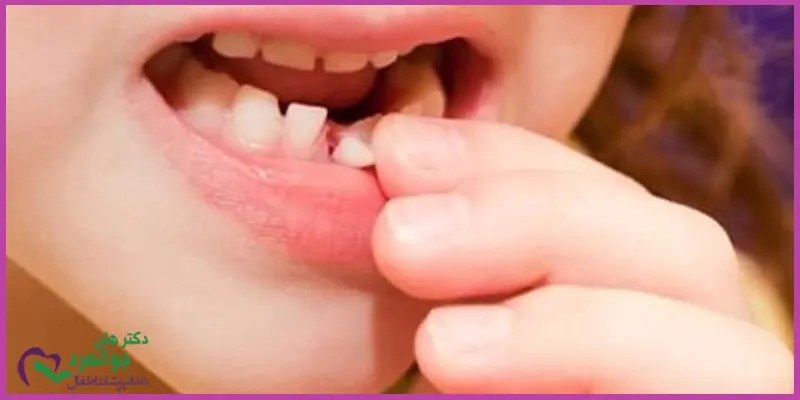 عوارض-دیر-افتادن-دندان-شیری